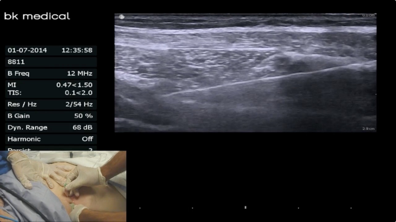 Ultrasound Guided Posterior TAP Block TAP, Quadratus Lumborum